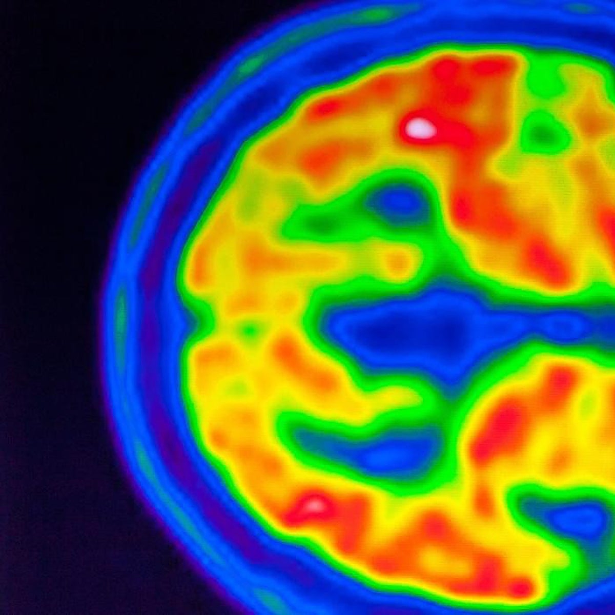El nuevo fármaco para el alzhéimer se asocia con dos muertes