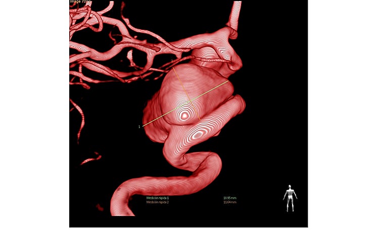 Imagen principal -  Arteriografía 3D de aneurisma cerebral en carótida interna izquierda de gran tamaño (15 mm). Arteriografía 3D tras la implantación de stent diversor de flujo en arteria carótida, que muestra trombosisicon cierre total del aneurisma del stent diversor de flujo durante su implantación en el procedimiento. Visualización radiológica del stent diversor de flujo durante su implantación en el procedimiento