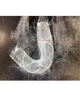 Imagen secundaria 2 -  Arteriografía 3D de aneurisma cerebral en carótida interna izquierda de gran tamaño (15 mm). Arteriografía 3D tras la implantación de stent diversor de flujo en arteria carótida, que muestra trombosisicon cierre total del aneurisma del stent diversor de flujo durante su implantación en el procedimiento. Visualización radiológica del stent diversor de flujo durante su implantación en el procedimiento
