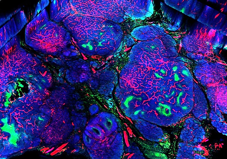 Investigadores españoles identifican una nueva diana para el tratamiento de un cáncer de mama resistente