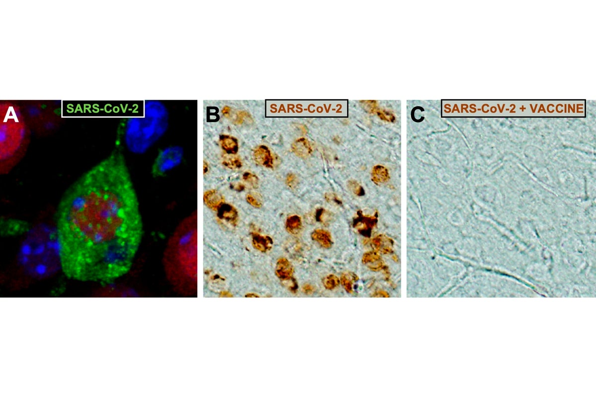 Neurona de la corteza cerebral infectada con el coronavirus SARS-CoV-2 (partículas virales en verde). B y C) En B, neuronas corticales infectadas por SARS-CoV-2 (en marrón) y, en C, ausencia de infección en la misma región cerebral de ratones vacunados con MVA-CoV2-S