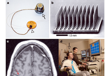 Un ensayo clínico confirma el potencial de los implantes de electrodos en ELA