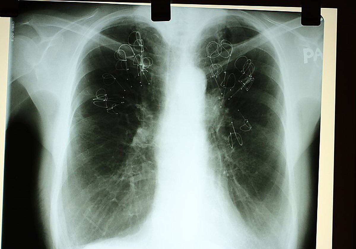 Si bien se han reducido los casos de cáncer de pulmón en hombres, ha aumentado en mujeres.