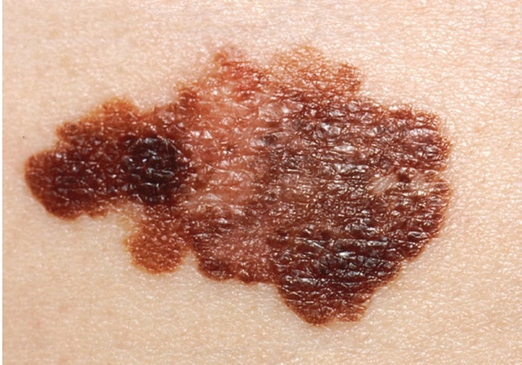 En melanoma, no es sólo lo que das, sino cuándo lo das