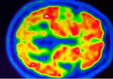 Alzheimer y colesterol, una relación tóxica