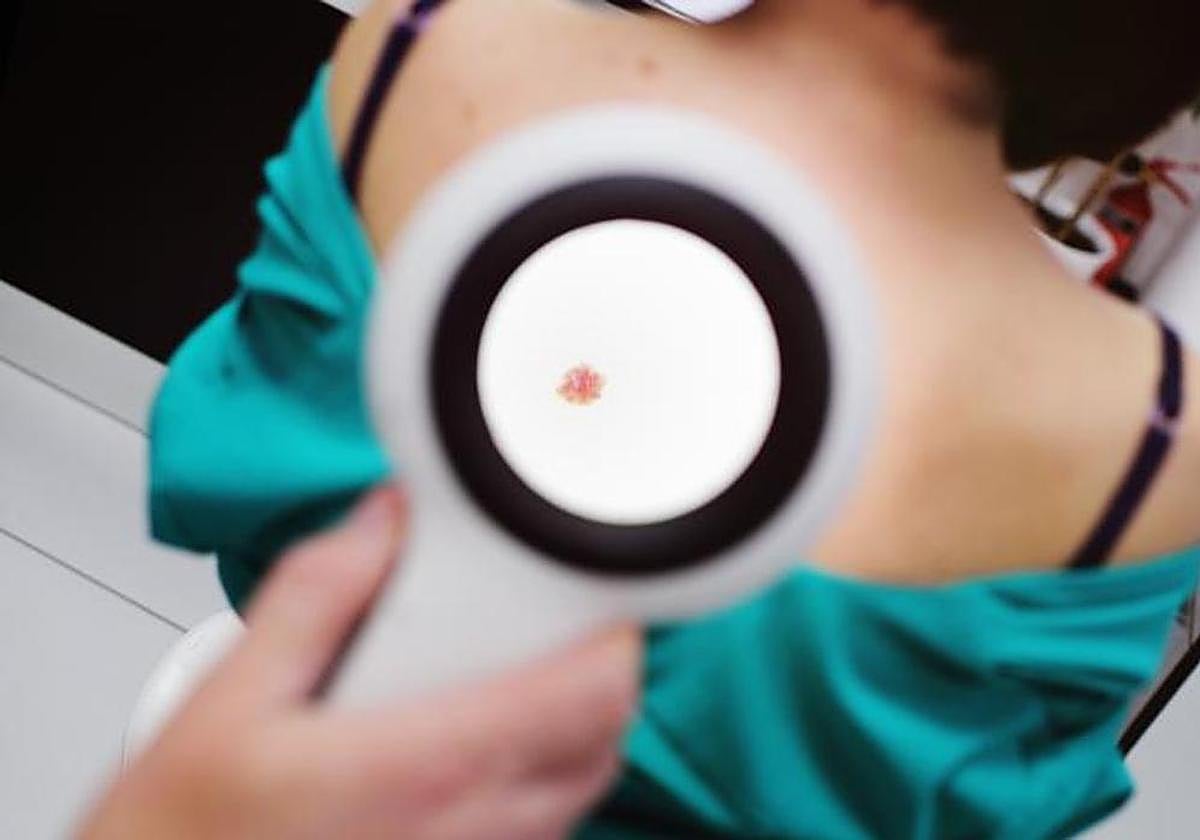 Un cambio en la piel es el signo más común de cáncer de piel, según los expertos