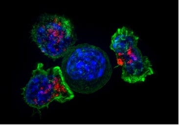 La terapia combinada que ataca al cáncer de páncreas