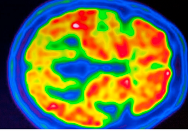 Lecanemab, un fármaco contra el Alzheimer, podría evitar que la beta amiloide dañe el cerebro