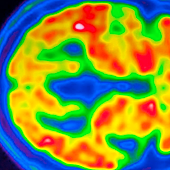 Lecanemab, un fármaco contra el Alzheimer, podría evitar que la beta amiloide dañe el cerebro