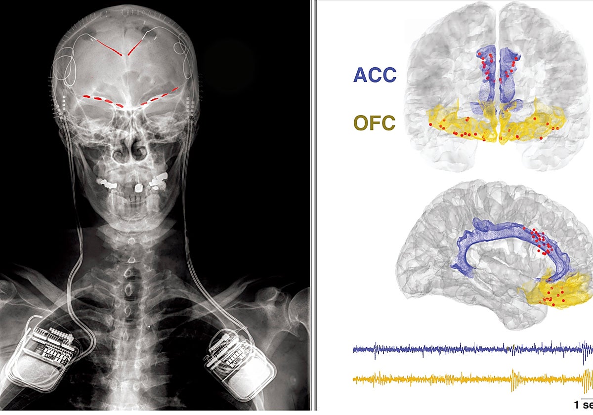 Radiografía de un participante del estudio, que muestra electrodos de registro cerebral implantados (parches rojos) conectados a un implante de registro/estimulación cerebral bidireccional en ambos lados. A la izda.,Esquema compuesto de cerebro coronal (arriba) y sagital (abajo) que muestra las ubicaciones de los contactos de los electrodos implantados en todos los participantes (puntos rojos). La corteza cingulada anterior se muestra en púrpura y la corteza orbitofrontal se muestra en amarillo. Grabaciones de señales cerebrales de ejemplo de cada región que se muestra en la parte inferior.