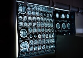 Científicos descubren un tratamiento que ralentiza la progresión de un tipo de cáncer cerebral incurable