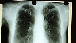 España diagnosticará este año 280.000 casos de cáncer: colon, recto, pulmón y mama serán los más frecuentes