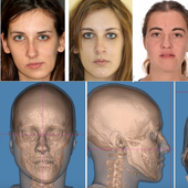 Cirugía ortognática: la solución para la corrección de maloclusiones dentales y asimetrías faciales