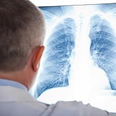 Una terapia diseñada en España aumenta la supervivencia en cáncer de pulmón