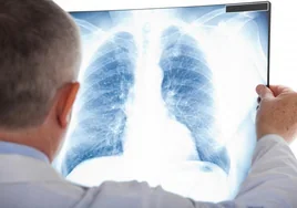 Una terapia diseñada en España aumenta la supervivencia en cáncer de pulmón