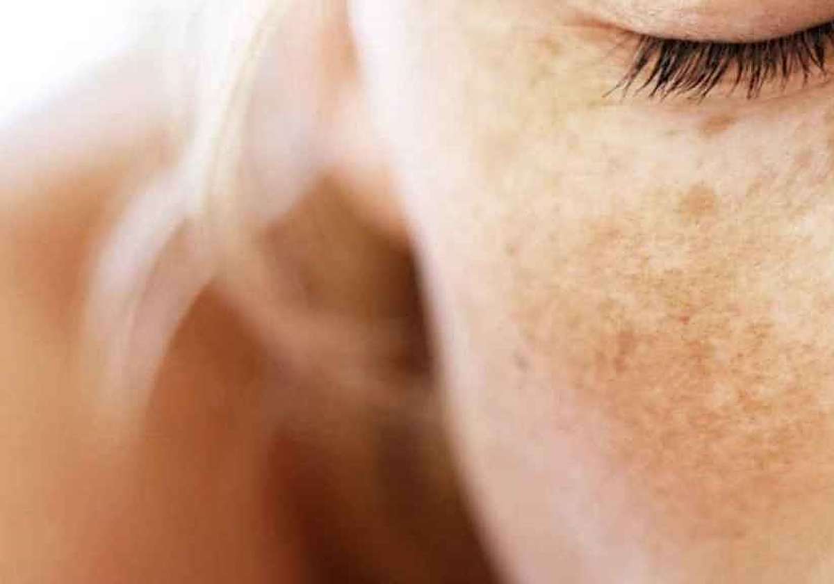 Manchas en la piel