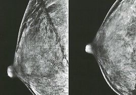 La inteligencia artificial, tan eficaz como dos radiólogos buscando tumores de mama al mismo tiempo