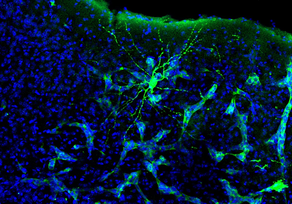 Metástasis en el cerebro de ratón (en verde claro y neurona en verde más intenso)