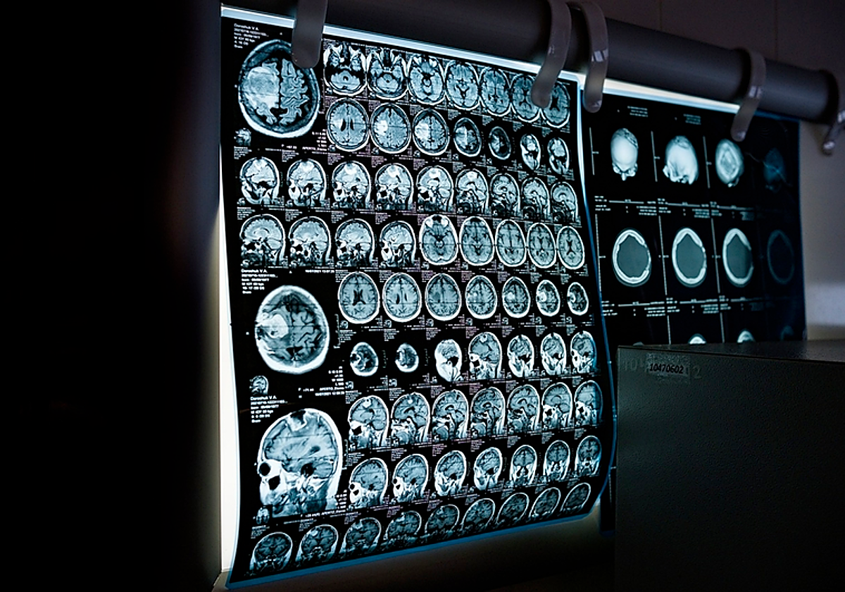 El glioblastoma, el tumor cerebral más frecuente en los adultos
