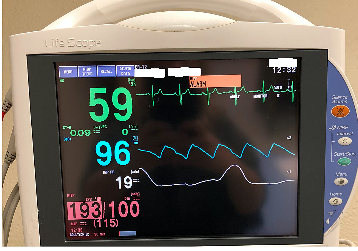 Ritmo anómalo del corazón en un electrocardiograma