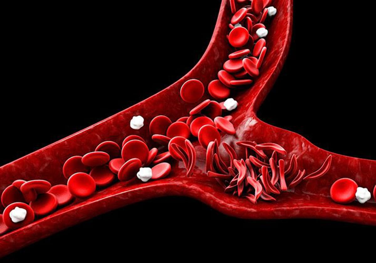 La anemia falciforme está causada por una mutación genética que fabrica glóbulos rojos anómalos. Deformes y pegajosos pueden formar grumos que bloqueen los vasos sanguíneos. Causan ictus, daño orgánico y crisis de dolor
