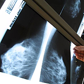 Haber tenido un falso positivo en un mamografía eleva el riesgo de cáncer de mama