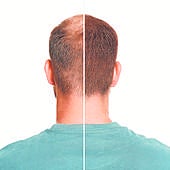 Lo último y lo que está por venir para frenar la alopecia