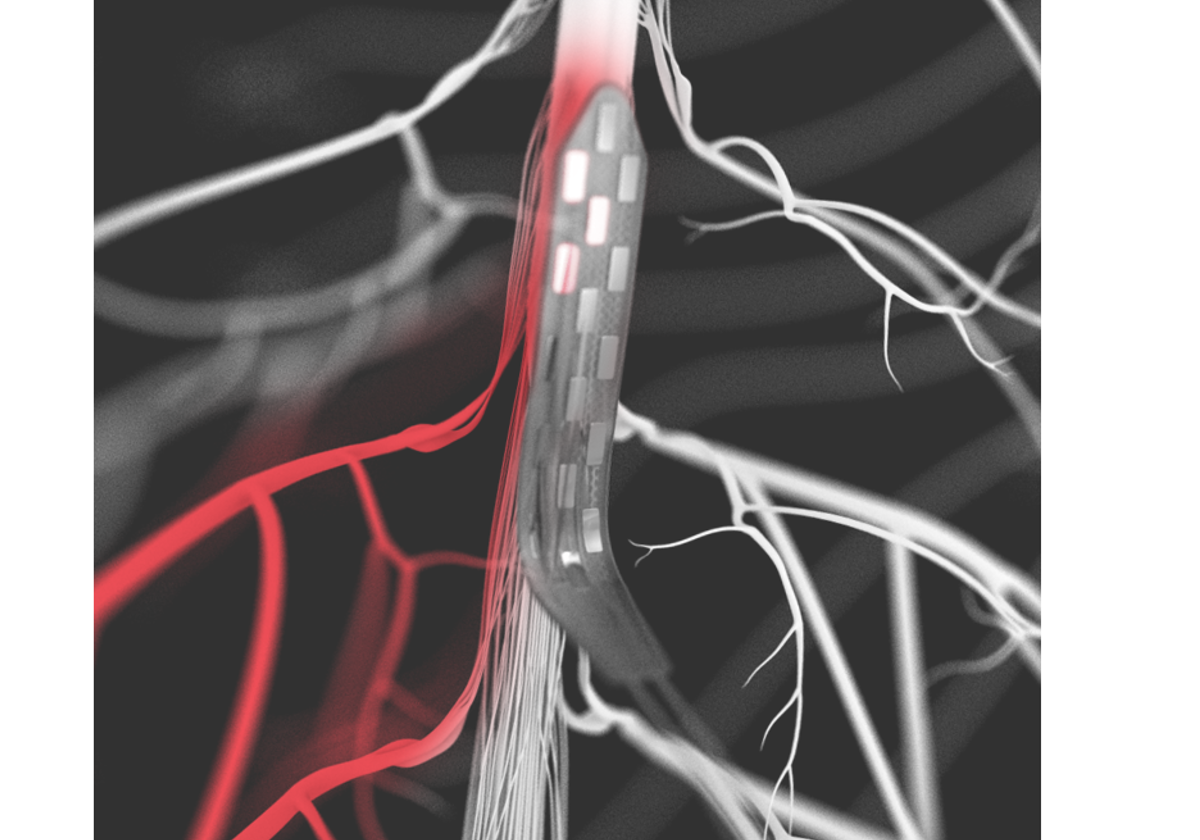 Imagen de la neuroprótesis