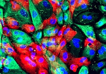 Una terapia experimental ataca el cáncer de próstata más resistente