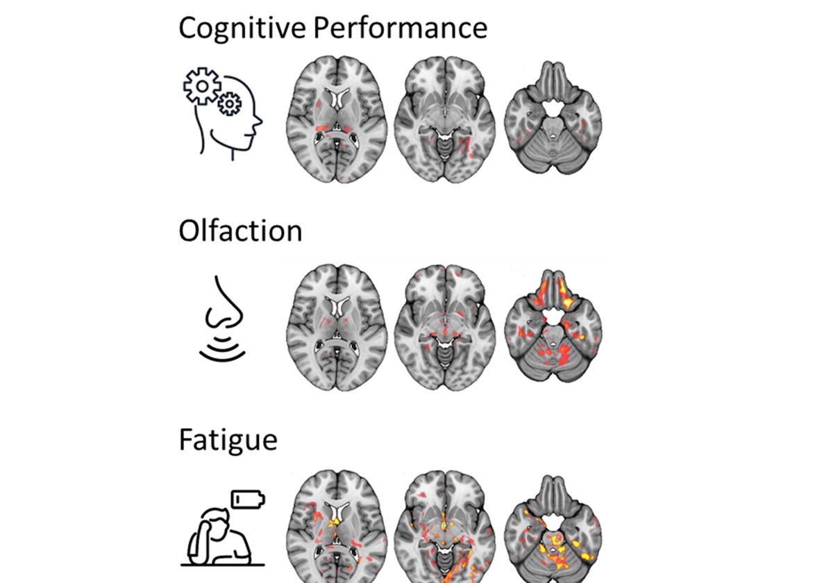 Cambios en el cerebro