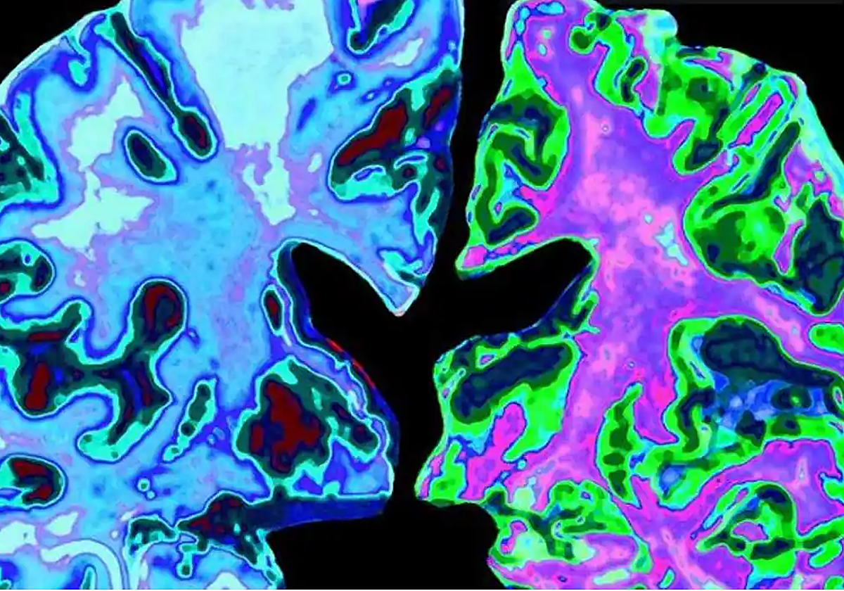 Un cerebro normal de una persona de 70 años (izquierda), comparado con el cerebro de una persona de 70 años con enfermedad de Alzheimer.