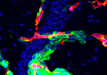 ¿Qué hace que unas células hagan metástasis en cáncer y otras no? Un estudio explica por qué