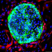 La terapia celular de nueva generación puede con un cáncer cerebral mortal