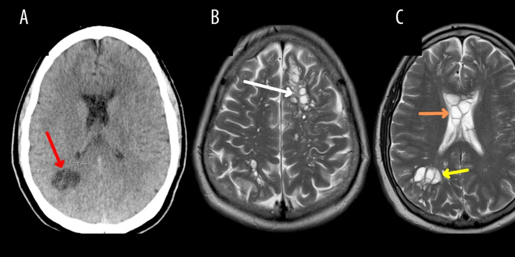 Tapeworms Discovered In Mans Brain After Eating Undercooked Bacon Time News