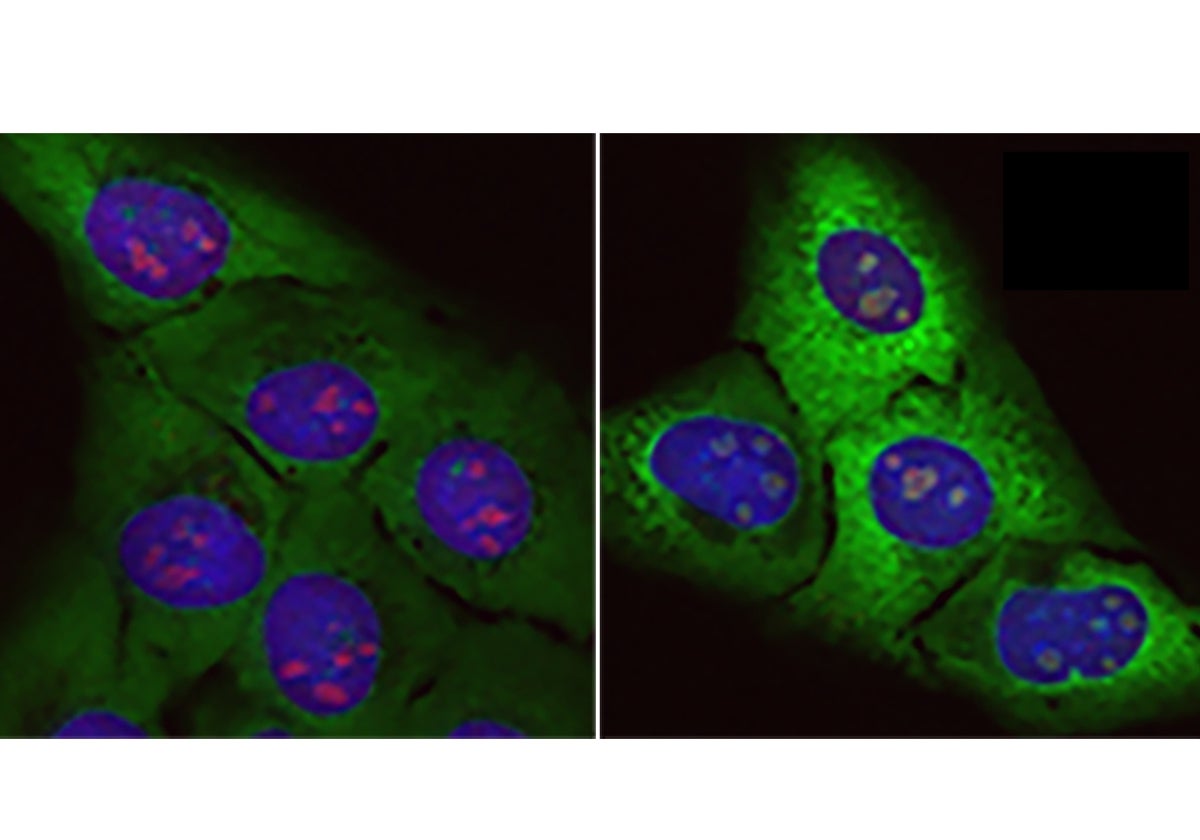 Acumulación de «proteínas basura»: Células normales (izquierda) y células sometidas al efecto de la proteína tóxica rica en arginina (derecha). En esta se incrementan las proteínas ribosomales (verde fluorescente) y el tamaño de los nucléolos (rojo).