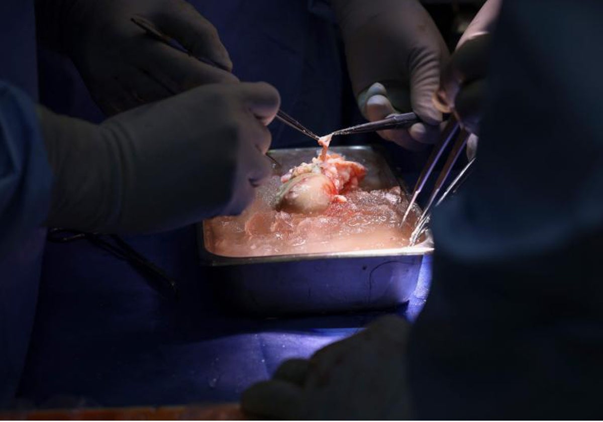 Este es el riñón de cerdo modificado genéticamente que fue implantado en un hombre de 62 años