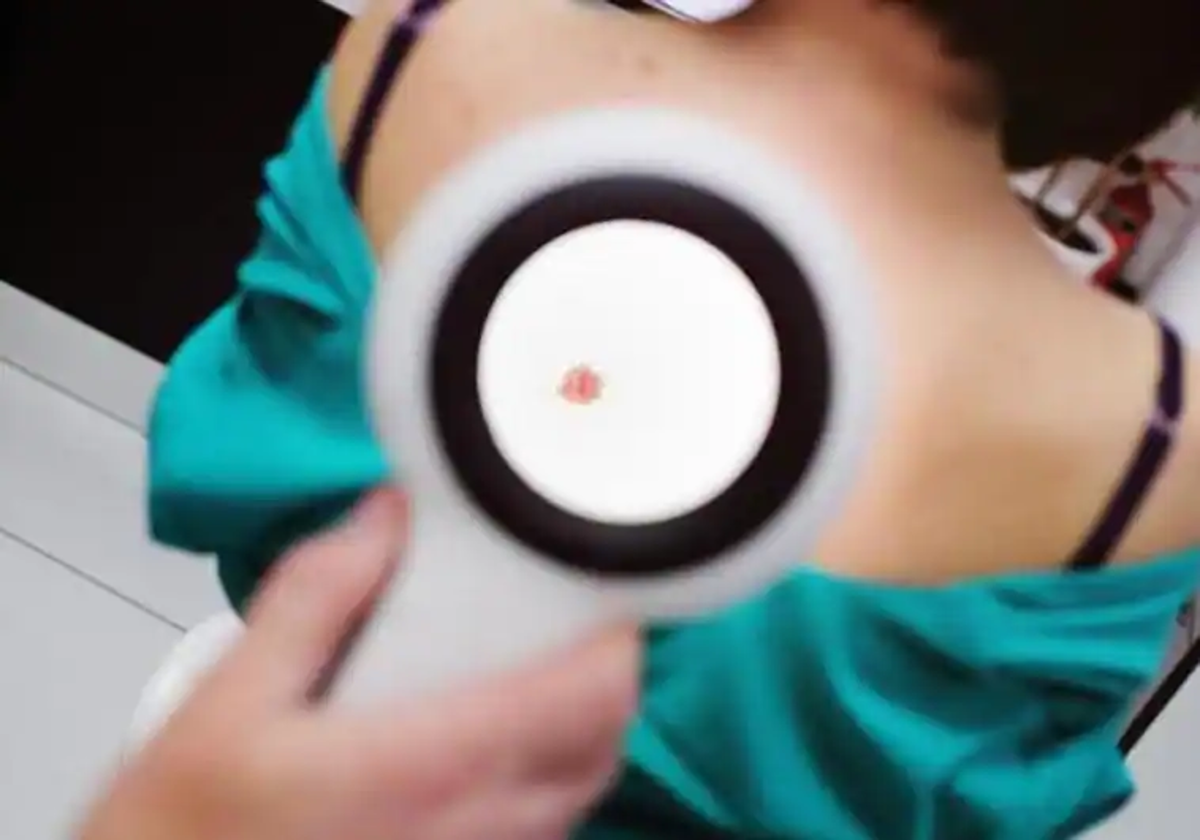 Melanoma