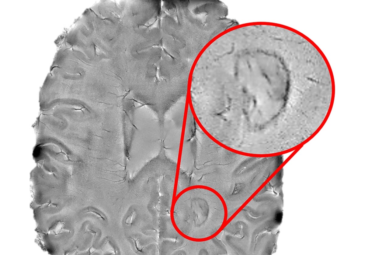 Cerebro de un pciente con EM