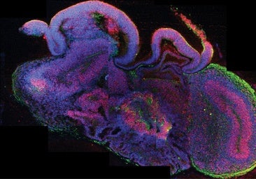 Curan un enfermedad rara gracias al uso de cerebros de laboratorio