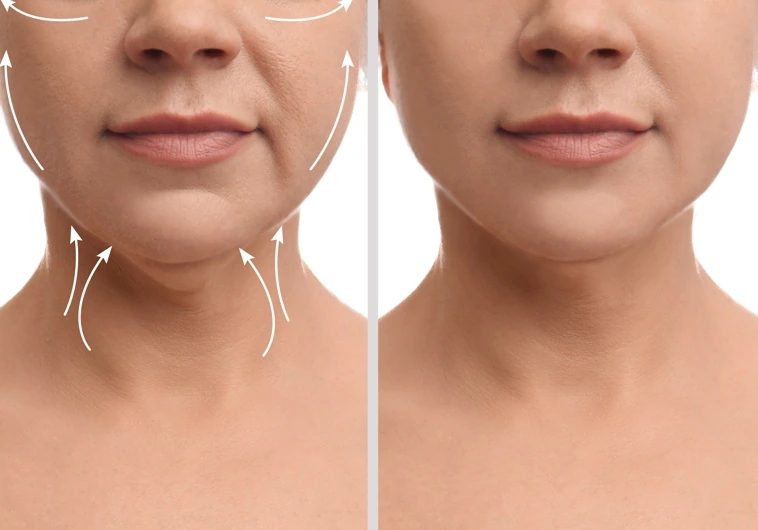 Una mujer, antes y después de una intervención estética.