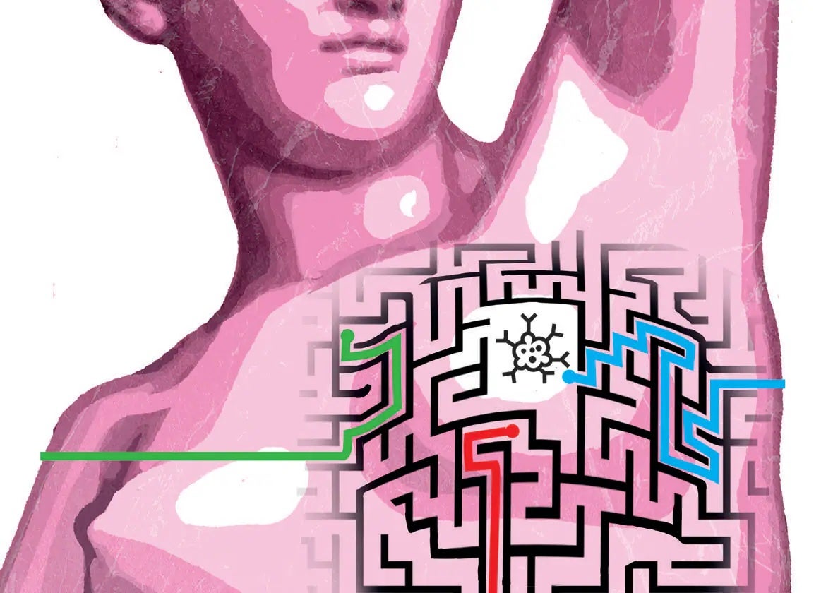 Ilustración de un cáncer de mama