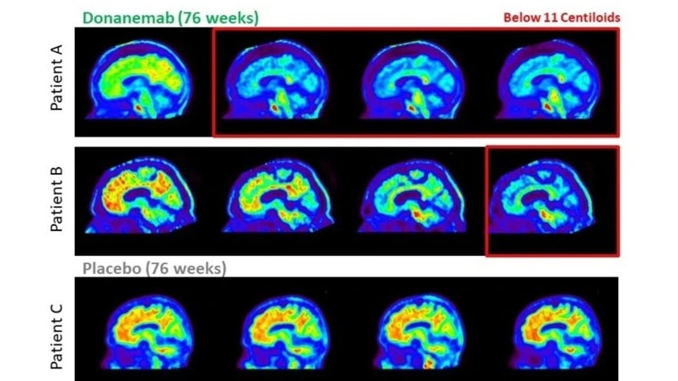 Imágenes del cerebro de dos pacientes (A y B) que recibieron donanemab en los ensayos clínicos muestran la eliminación de la placa amiloide. El paciente C recibió placebo