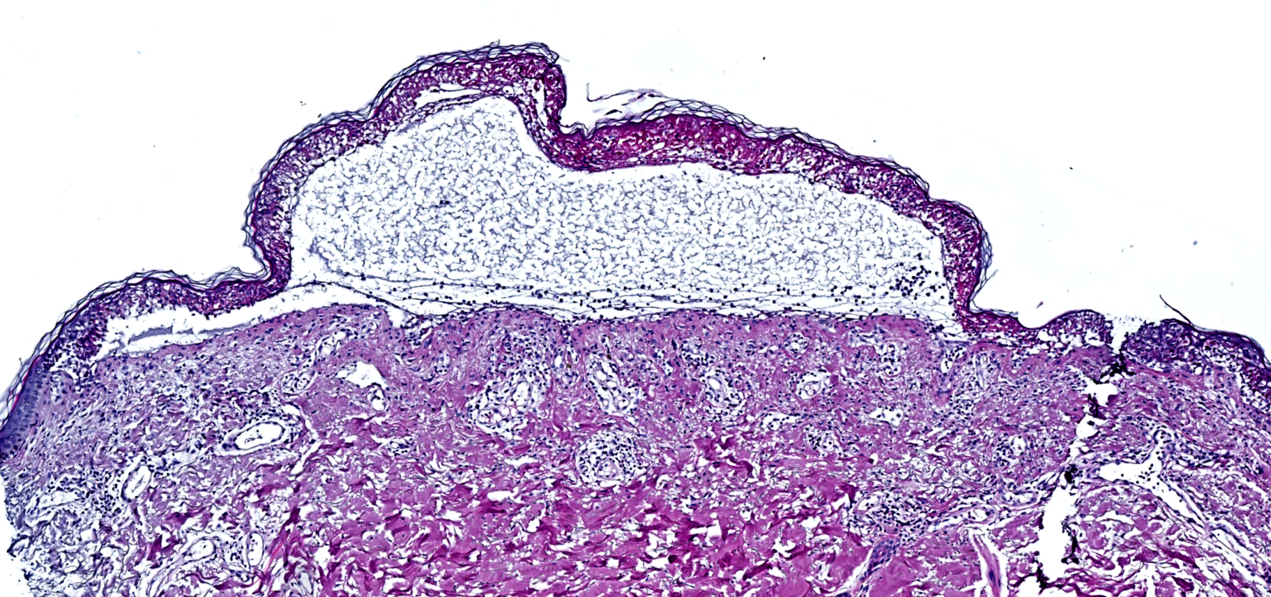 Damage to the epidermis due to toxic epidermal necrolysis