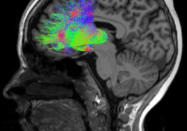 Así reacciona el cerebro de una persona con esquizofrenia ante un dilema