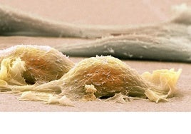 Un fármaco inmunoterápico mejora los resultados en sarcoma de tejidos blandos