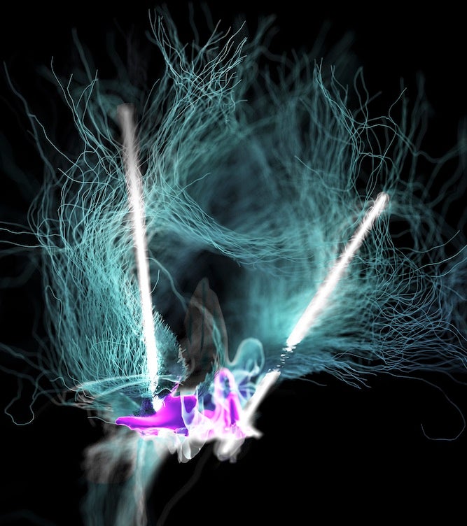 Una representación visual de la estimulación cerebral profunda del hipotálamo lateral
