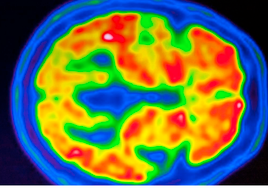 La esquizofrenia se refleja en la estructura cerebral de cada persona