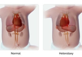 Este gen descoloca los órganos y causa defectos cardíacos fatales en niños