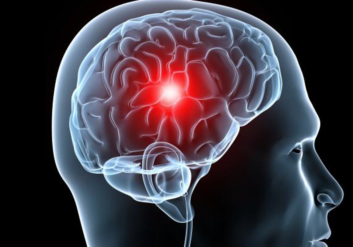 Cada vez hay más casos de ictus en menores de 50 años