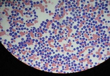 Una innovadora terapia CAR-T española rescata a pacientes con linfoma